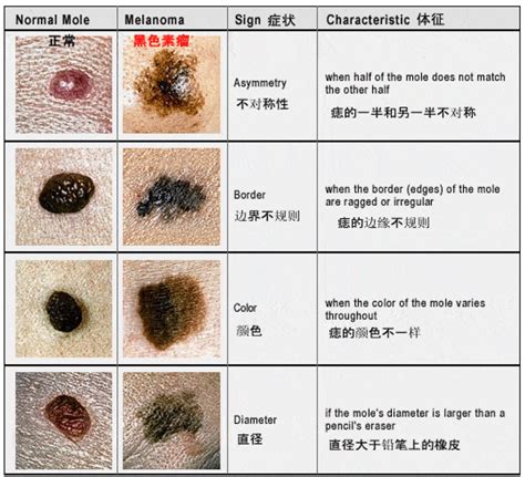 身体痣|为什么身上突然长出新痣？容易恶变吗？